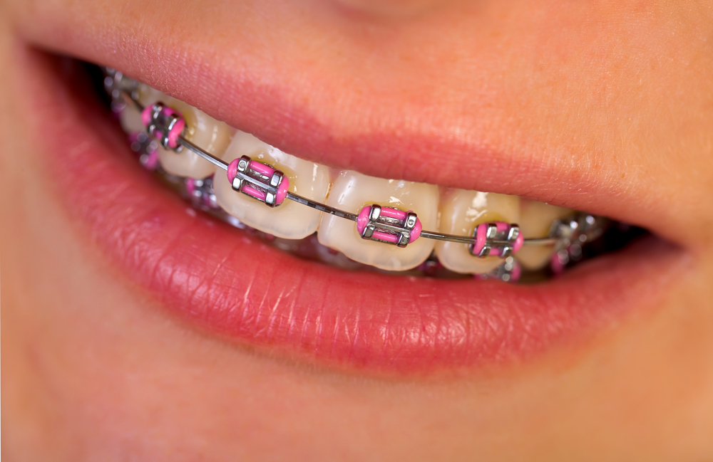 How Do Braces Operate To Straighten Your Teeth?